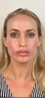 dermal-fillers-after