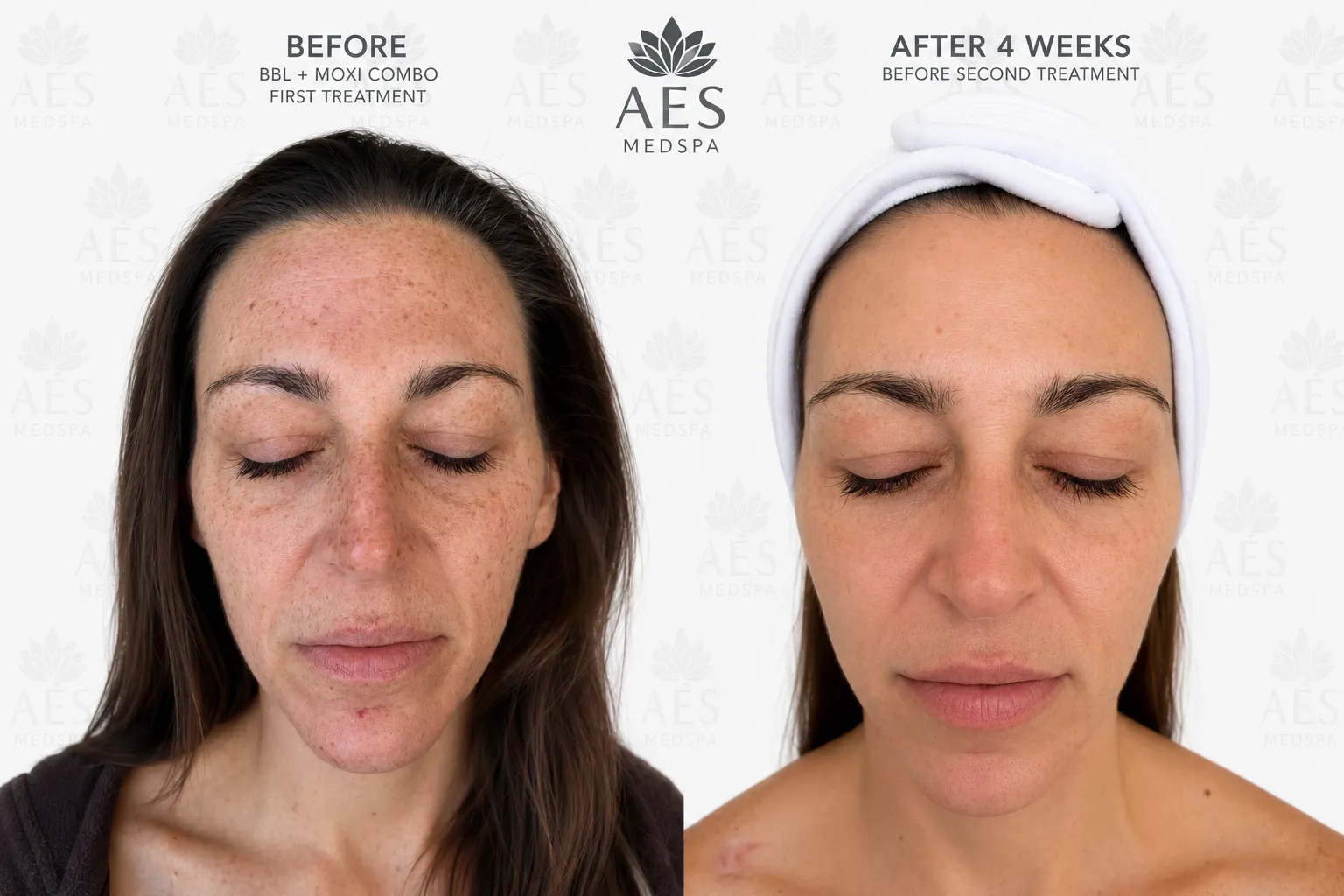 Real patient before and after BBL and MOXI laser treatment showing improvement in sun damage and pigmentation at AES Med Spa