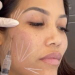 Sculptra®