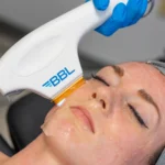 BBL Photofacial