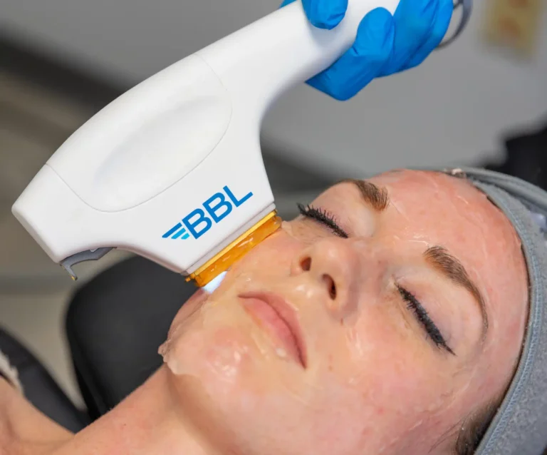 BBL Photofacial