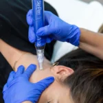 SkinPen® Session