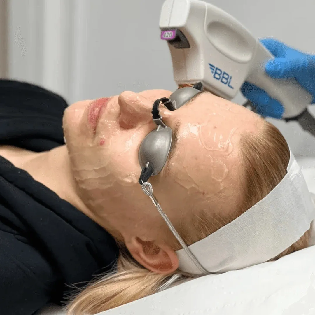 BBL and MOXI laser treatment at AES Med Spa
