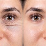 Venus Viva Skin Resurfacing